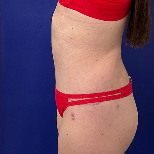 after halo lift left view female patient case 5458