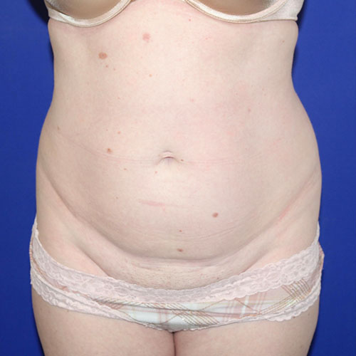 before halo lift front view female patient case 5458