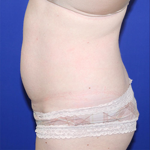 before halo lift left view female patient case 5458