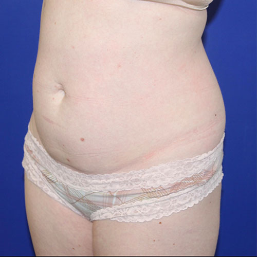 before halo lift left angle view female patient case 5458