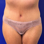 after halo lift front view female patient case 5467