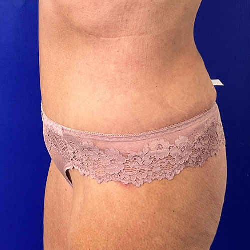 after halo lift left view female patient case 5467