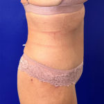 after halo lift right view female patient case 5467