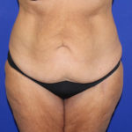 before halo lift front view female patient case 5467