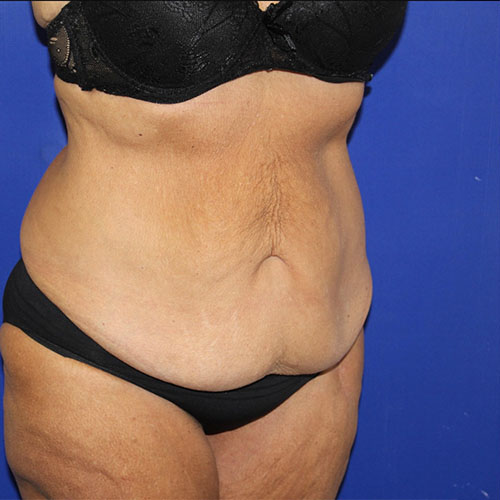 before halo lift right angle view female patient case 5467