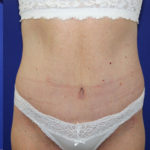 after halo lift front view female patient case 5476