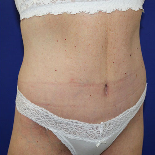 after halo lift right angle view female patient case 5476