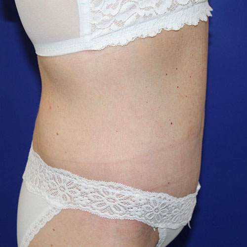 after halo lift right view female patient case 5476