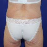 after halo lift back view female patient case 5476