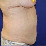 before halo lift right view female patient case 5476