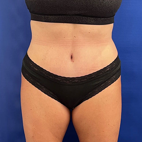 after lipoabdominoplasty front view female patient case 5493