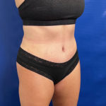 after lipoabdominoplasty right angle view female patient case 5493